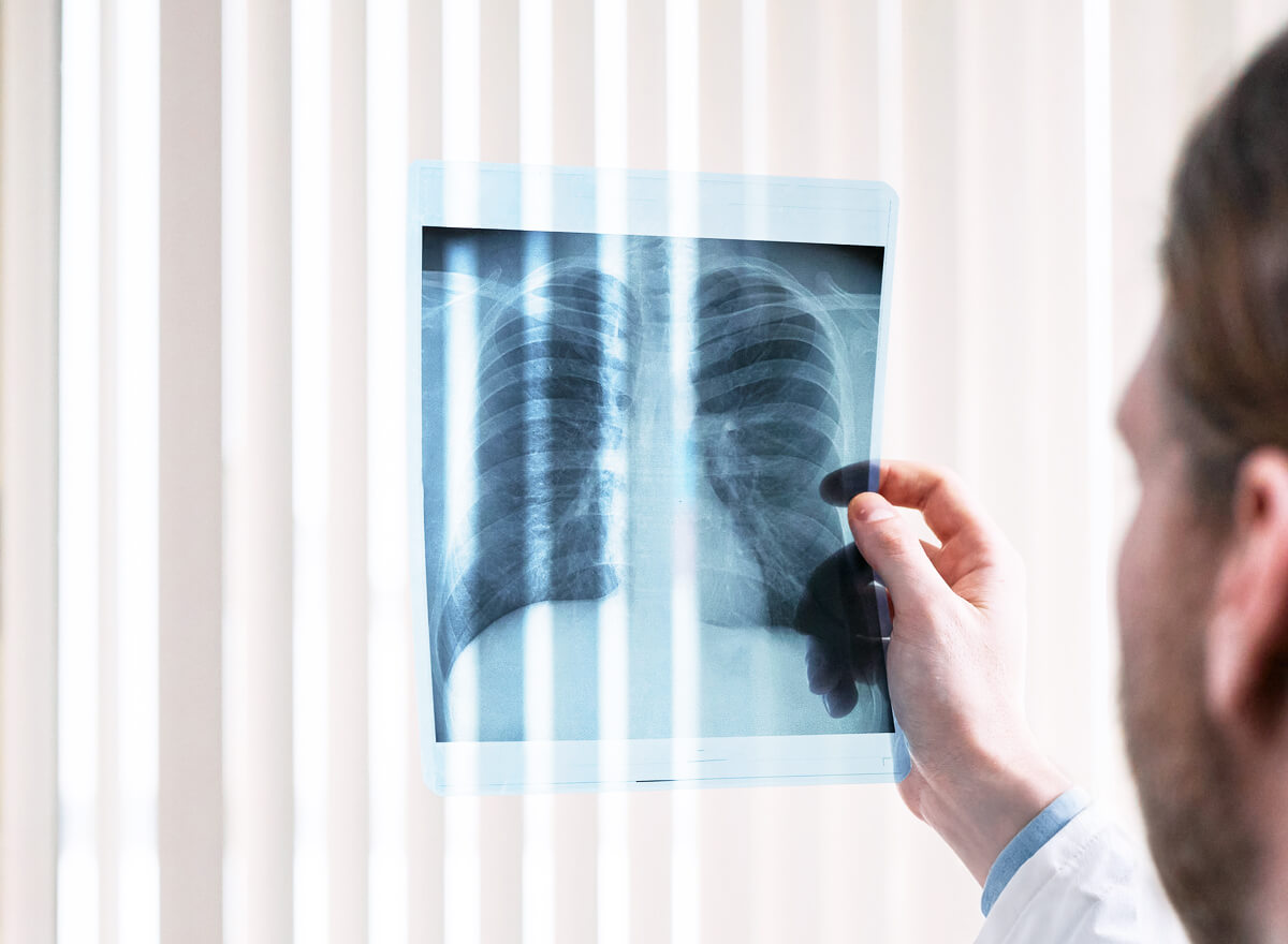 lungs X-ray of lungs